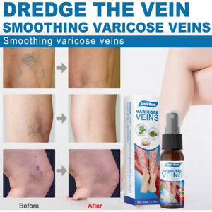 Veins Treatment Spray