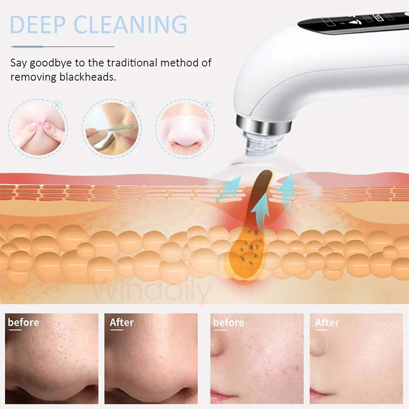 HydraFacial Bubble Blackhead Remover