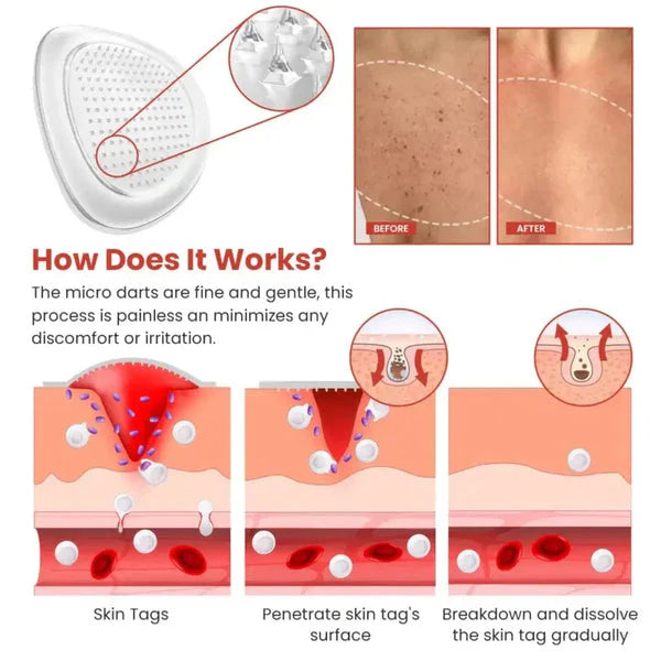 Skin Tag Remover Patch - SHOPIZEM