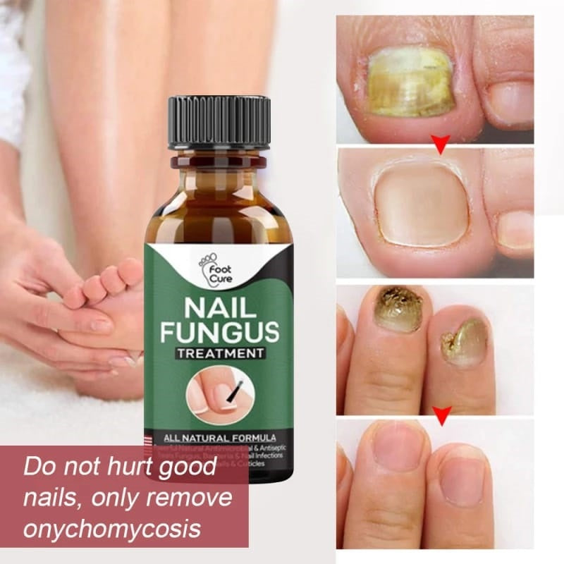 Fast Nail Fungal Treatment: Nail Repair Essences Serum - SHOPIZEM