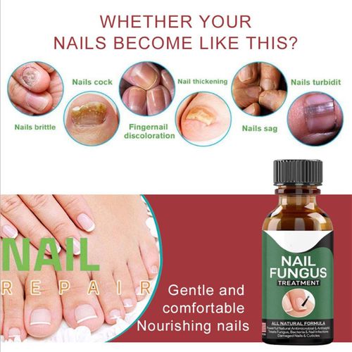 Fast Nail Fungal Treatment: Nail Repair Essences Serum