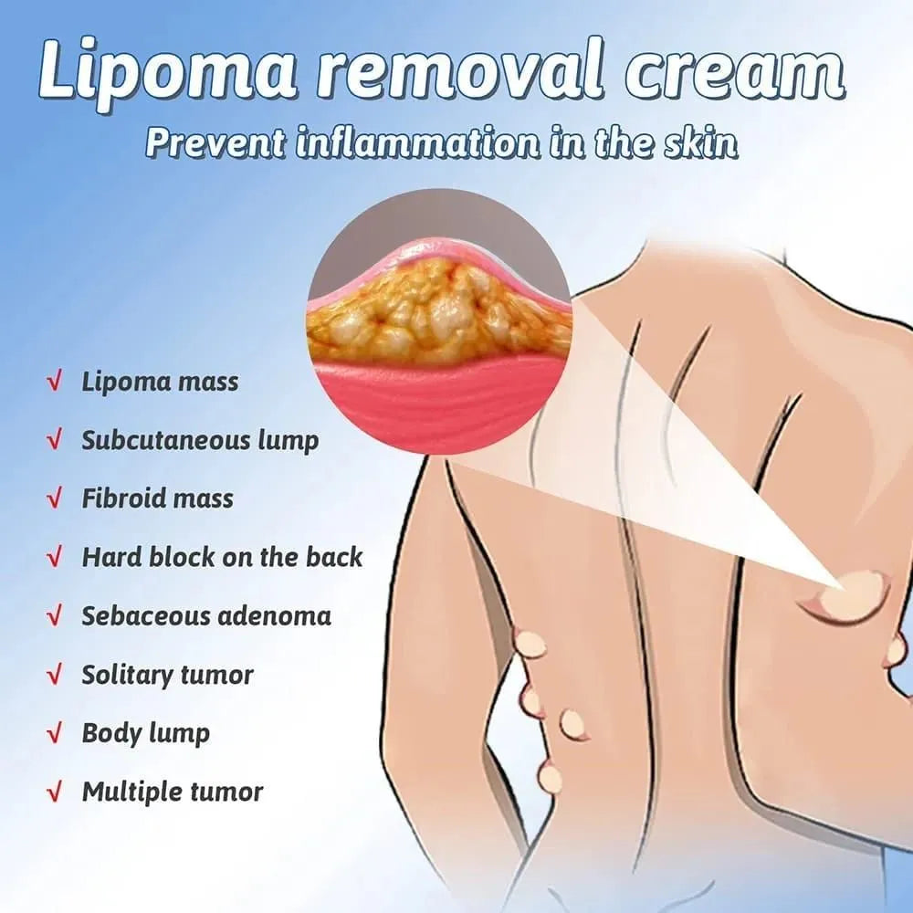 Lipoma Removal Cream - SHOPIZEM 