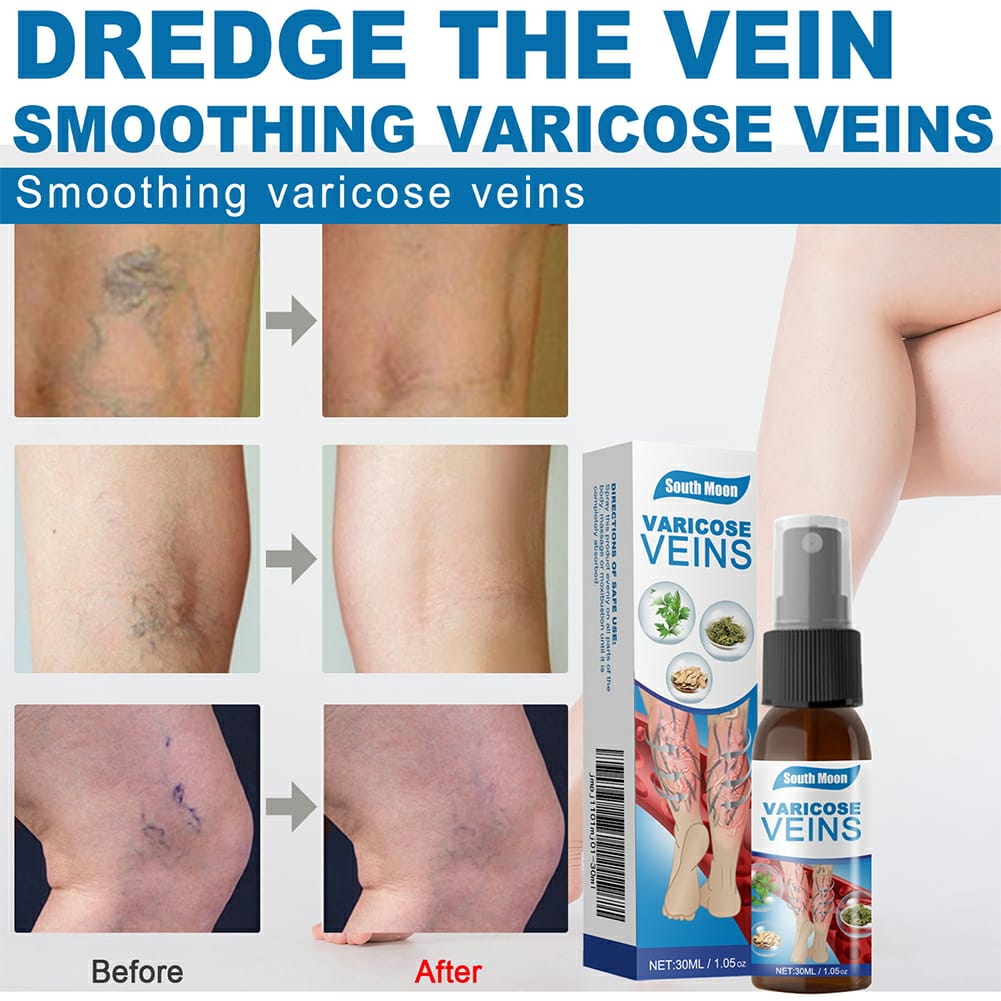 Varicose Veins Spray - SHOPIZEM 