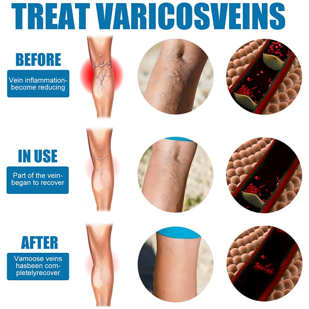 Varicose Veins Spray - SHOPIZEM 