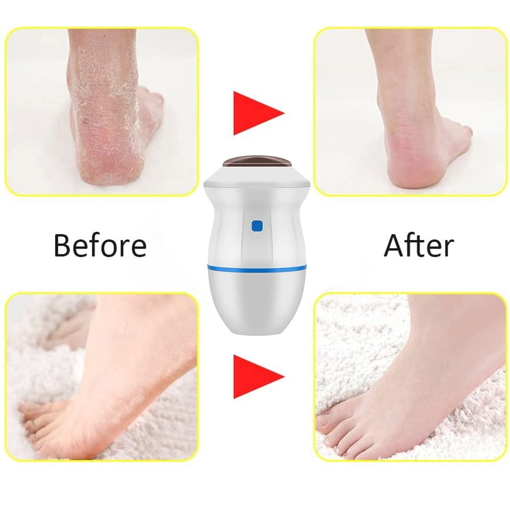 Electric Foot Callus Remover with Vacuum Absorption - SHOPIZEM