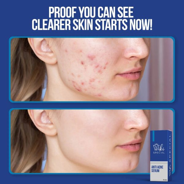 Wiki Special Anti Acne Serum - SHOPIZEM 